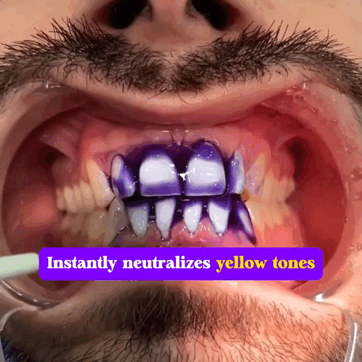 FALSH SALE 60% OFF + FREESHIP🔥V34 Teeth Whitening Serum ✨Dentist‑Developed Whitening Formula
