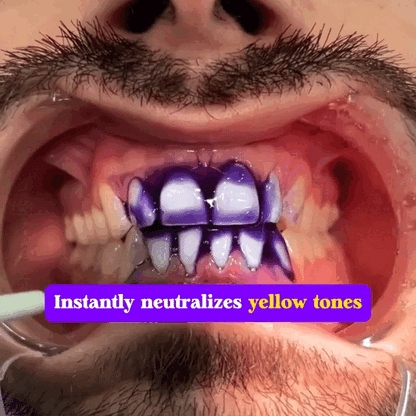 FALSH SALE 60% OFF + FREESHIP🔥V34 Teeth Whitening Serum ✨Dentist‑Developed Whitening Formula
