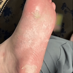 Last Day Promotion 60% OFF🔥 Orange Oil Foot Callus Removal Spray – Smooth & Callus-Free in 5 Minutes