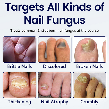 Last Day Promotion 60% OFF⏰ MycoRelief Pro Fungal Nail Patches✨ From Yellow to Healthy Nails in 5 Days