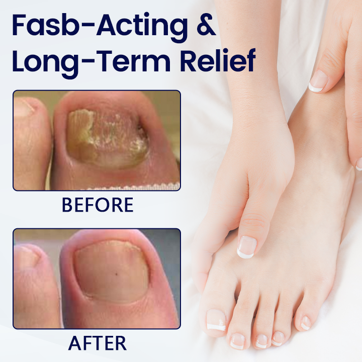 Last Day Promotion 60% OFF⏰ MycoRelief Pro Fungal Nail Patches✨ From Yellow to Healthy Nails in 5 Days