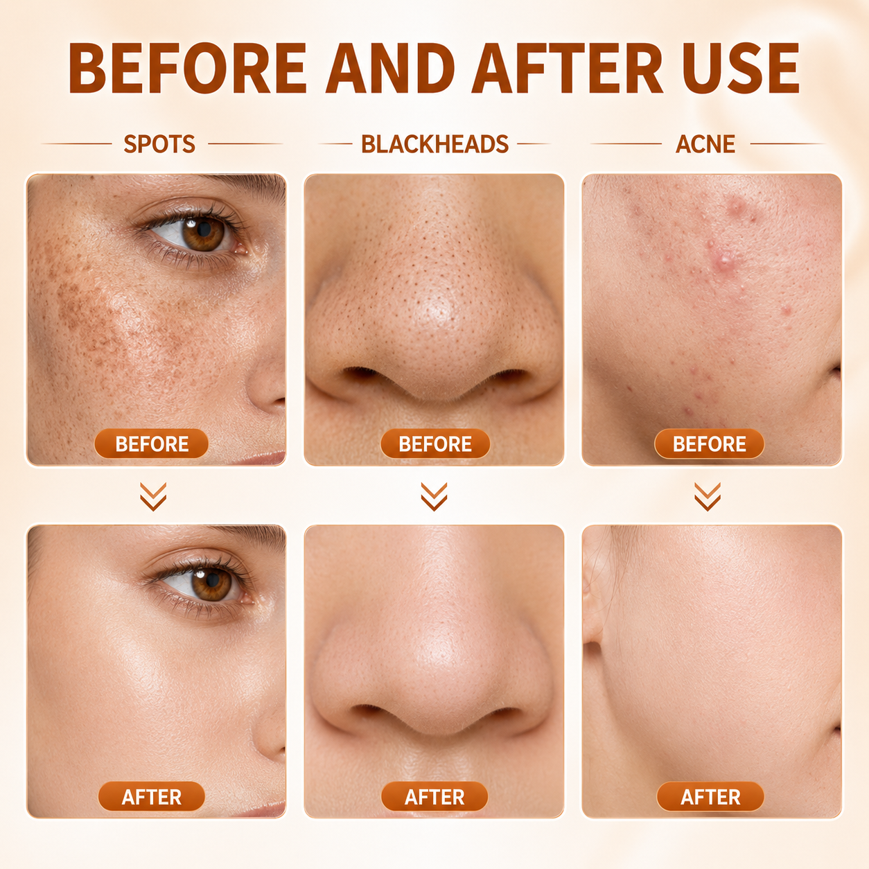 Last Day Promotion 60% OFF🔥 Herbal Spots Peel-Off Facial Mask