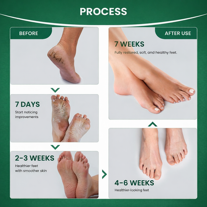 Foot Ginger Callus Remove Spray