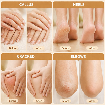 🔥HOT SALE 60% OFF🔥Advanced Heel Repair & Callus Care Cream - At-Home Solution for Dry, Cracked Skin