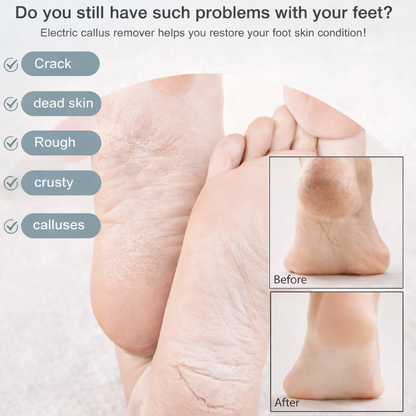 FLASH SALE 60% OFF + FREE SHIPPING⏰Electric Foot Callus Remover - 2026 Upgrade Version