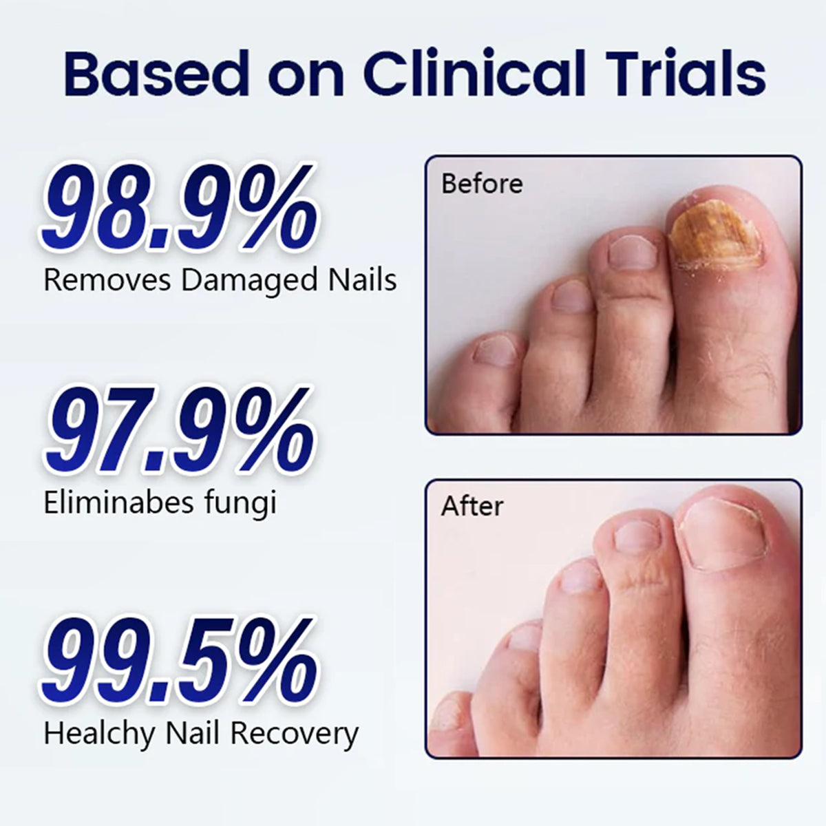 Last Day Promotion 60% OFF⏰ MycoRelief Pro Fungal Nail Patches✨ From Yellow to Healthy Nails in 5 Days