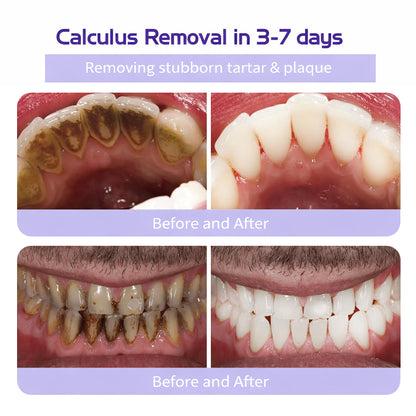 Last Day Promotion 60% OFF⏰ Teeth Whitening Mineral Powder  – Yellow Stains Gone in 3 Days