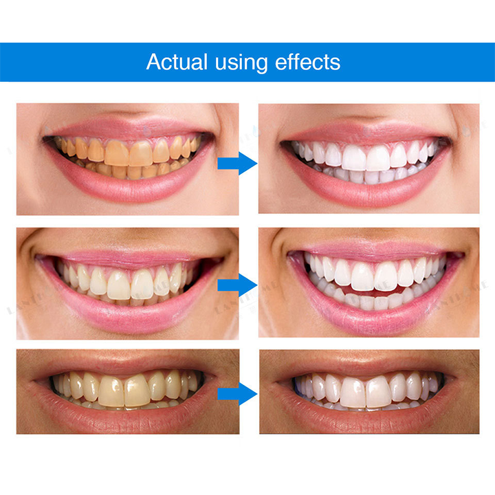 Instant Teeth Whitening Essence Pen🔥 LAST DAY SALE 60% OFF 🔥