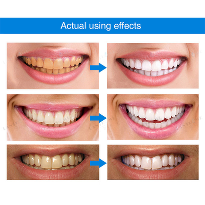 Instant Teeth Whitening Essence Pen🔥 LAST DAY SALE 60% OFF 🔥