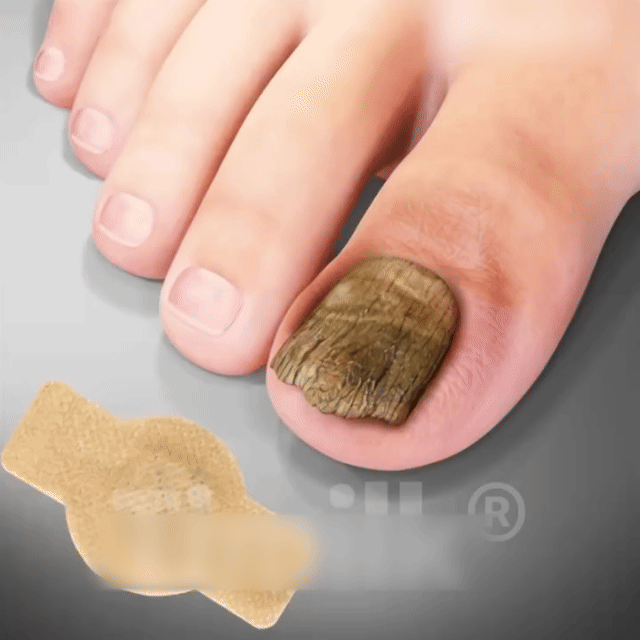 Last Day Promotion 60% OFF⏰ MycoRelief Pro Fungal Nail Patches✨ From Yellow to Healthy Nails in 5 Days