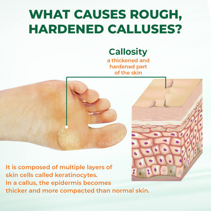 Last Day Promotion 60% OFF🔥 Orange Oil Foot Callus Removal Spray – Smooth & Callus-Free in 5 Minutes