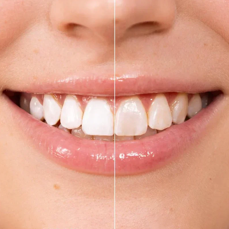 Instant Whitening Tooth Paint ✨ Made by Dentists Professional Teeth Whitening Formula